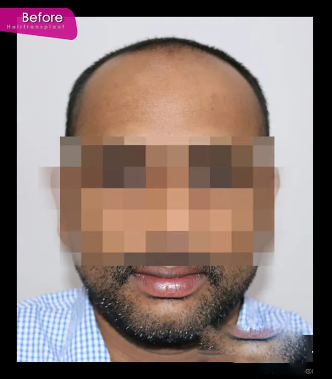 Before Hair Treatment