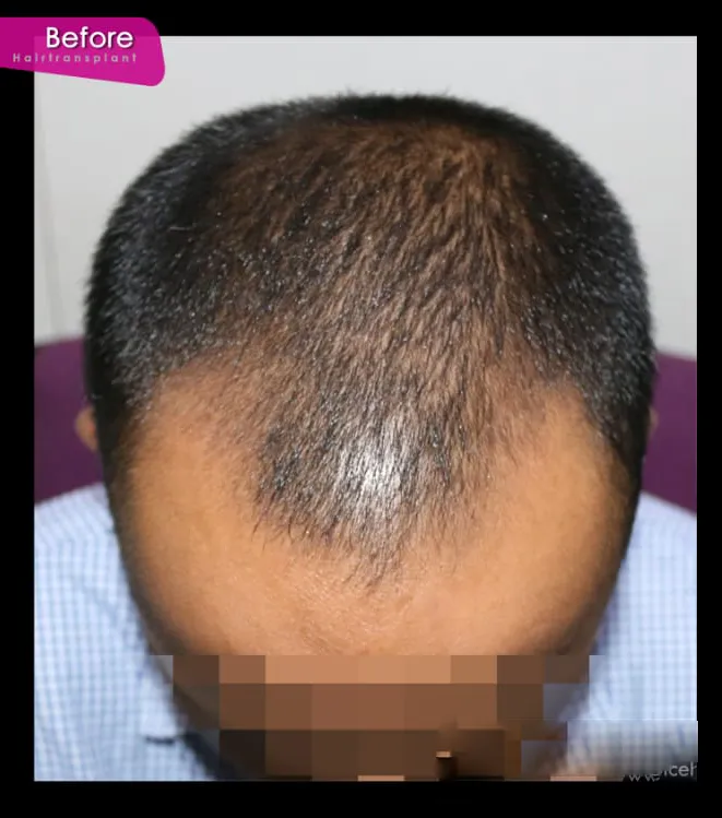 Before Hair Treatment