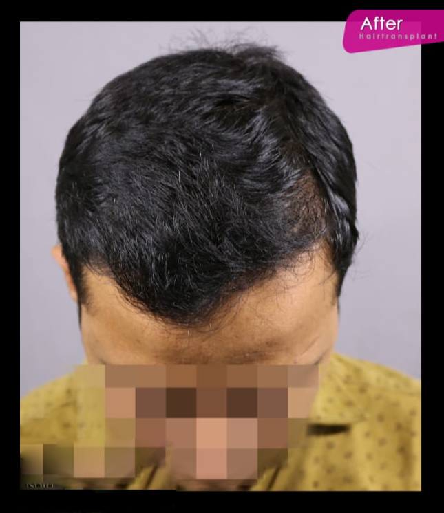 After Hair Treatment