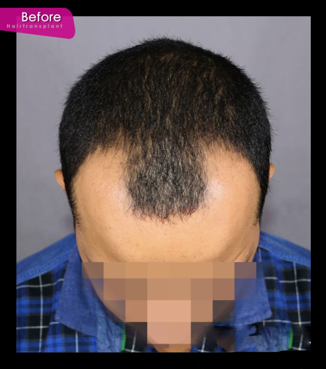 Before Hair Treatment