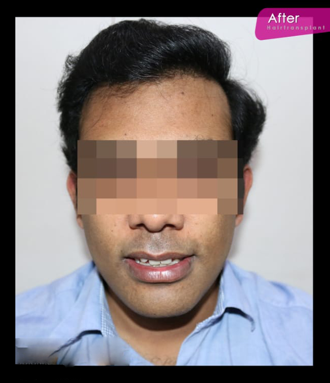 After Hair Treatment