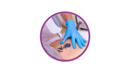 Tattoo Removal